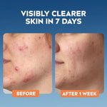 Nivea Derma Skin Clear Wash Gel - Blemish-Prone Skin 150ml